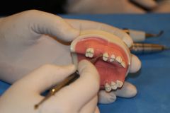 Maxillary Sinus Grafting_1