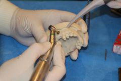 Maxillary Sinus Grafting_7