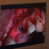 Immediate implementation and immediate loading_18