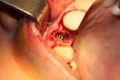 18 th International congress of Iranian association of oral and maxillofacial surgeons_23