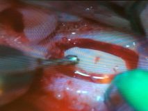 Sinus graft course with live surgey