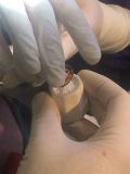 Sinus graft course with live surgey