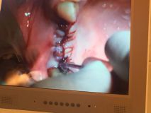 PeriAcryl tissue adhesive practical training with Live surgery