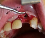 SPI system presentation with live surgery_16
