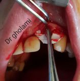معرفی سیستم SPI همراه با جراحی زنده و Immediate Loading - آبان ۹۵